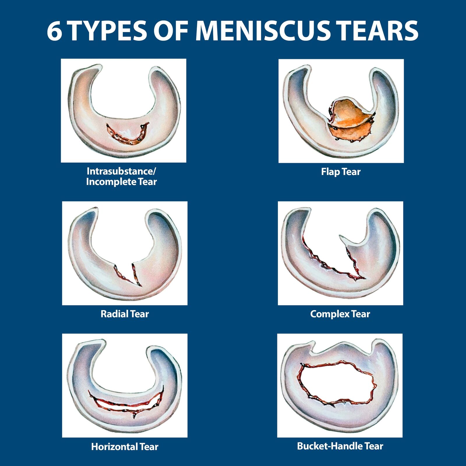 What Is A Torn Meniscus What Is A Torn Meniscus